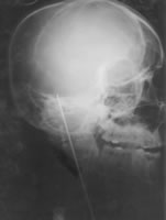 写真�A：金属ワイヤが脳に刺さったことを示唆するレントゲン写真