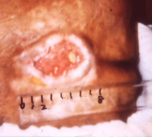 写真�A：仙骨部分にできた直径８センチの褥瘡