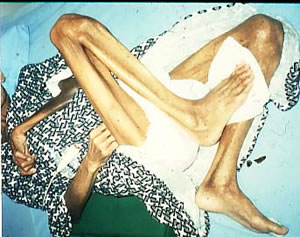 写真�@：日本の老人病院で「寝かせきり」にされ手足が鉤縮したお年寄り